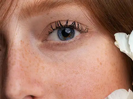 Botox for Eye Conditions – Strabismus & Blepharospasm