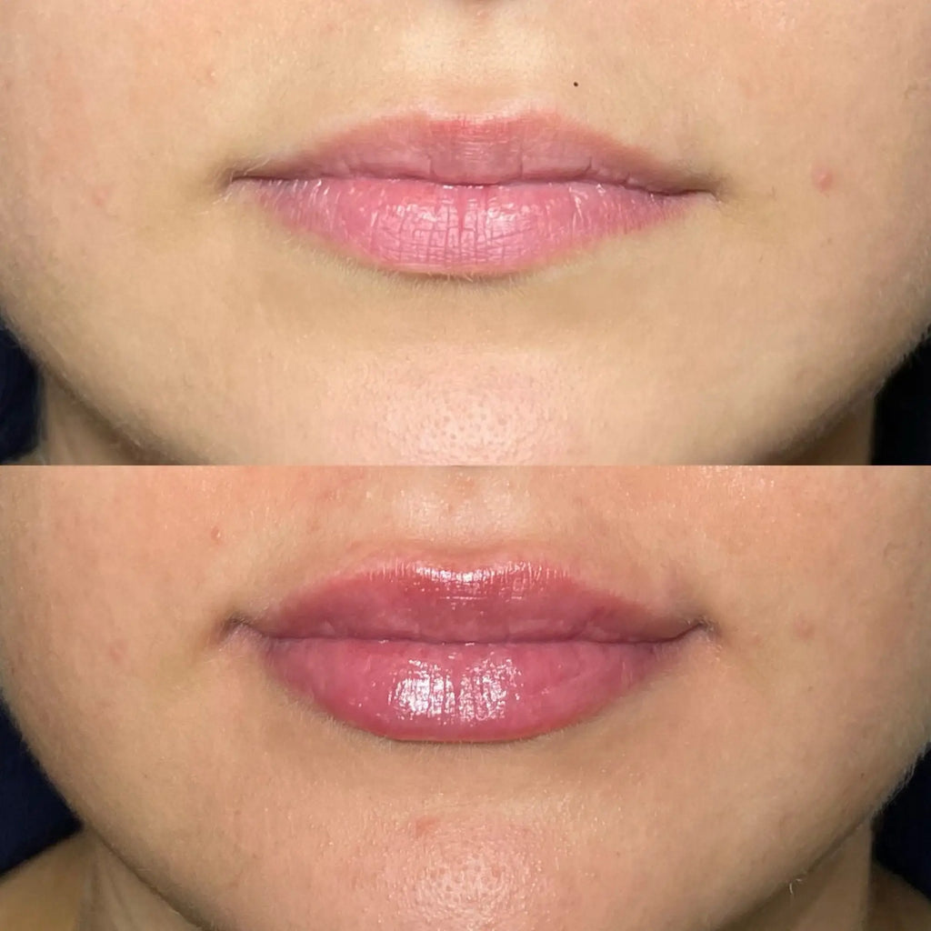Lip Filler Aftercare Advice