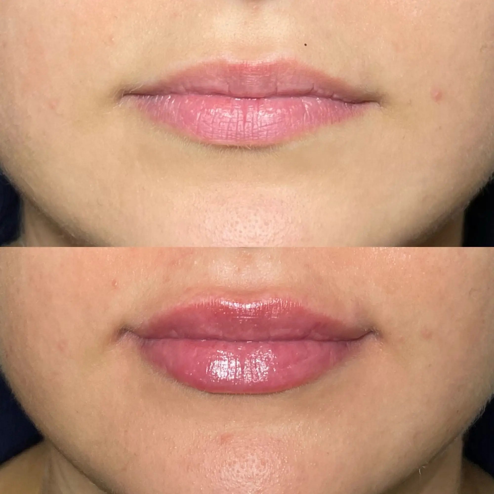 Lip Flip Before And After