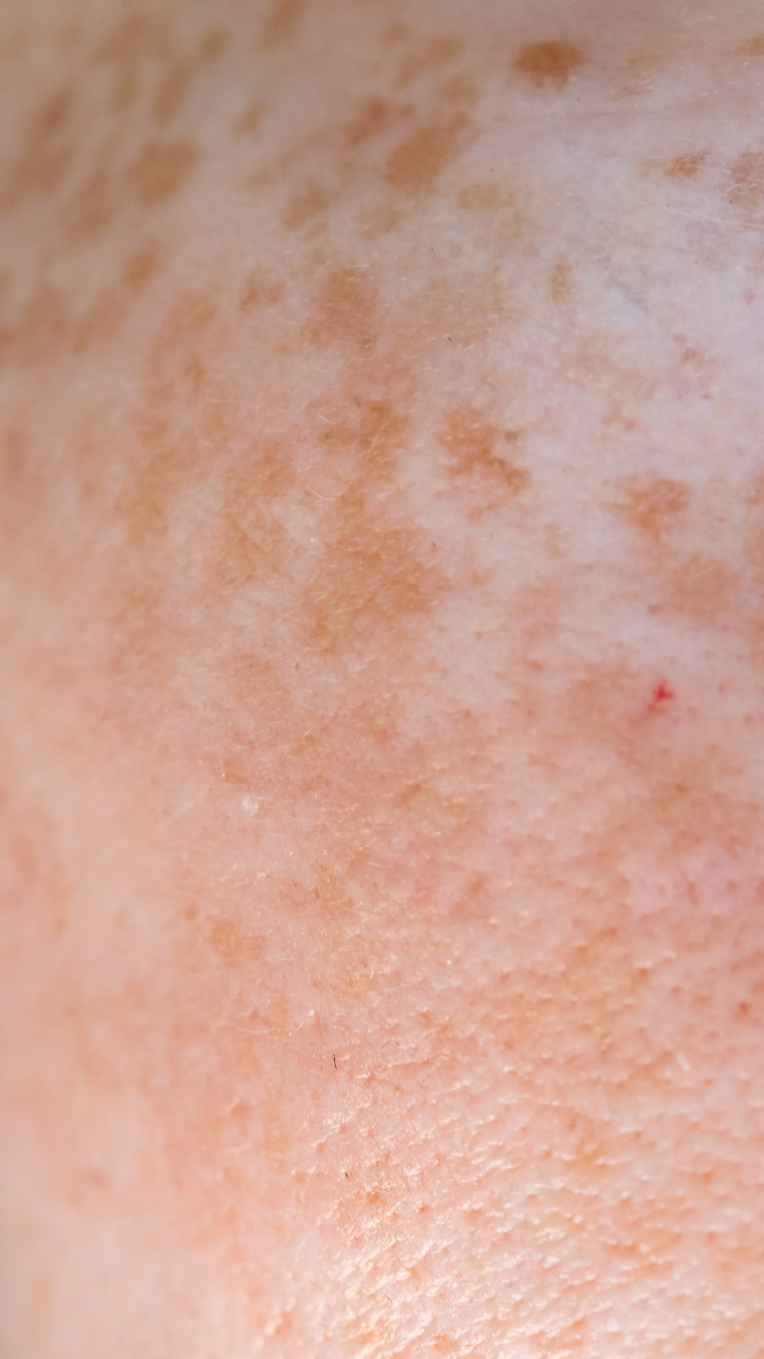 Pigmentation treatment at It’s Me and You Clinic in London, Kingston upon Thames and Surrey – targeted solutions including laser therapy, chemical peels and microneedling for dark spots and melasma.