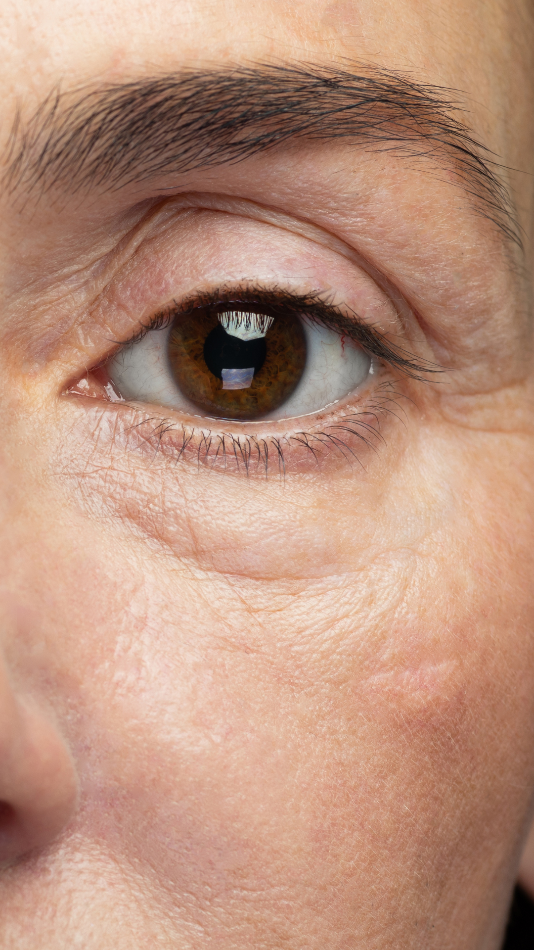 Bags under eyes treatment in London and Kingston, Surrey – It’s Me & You Clinic