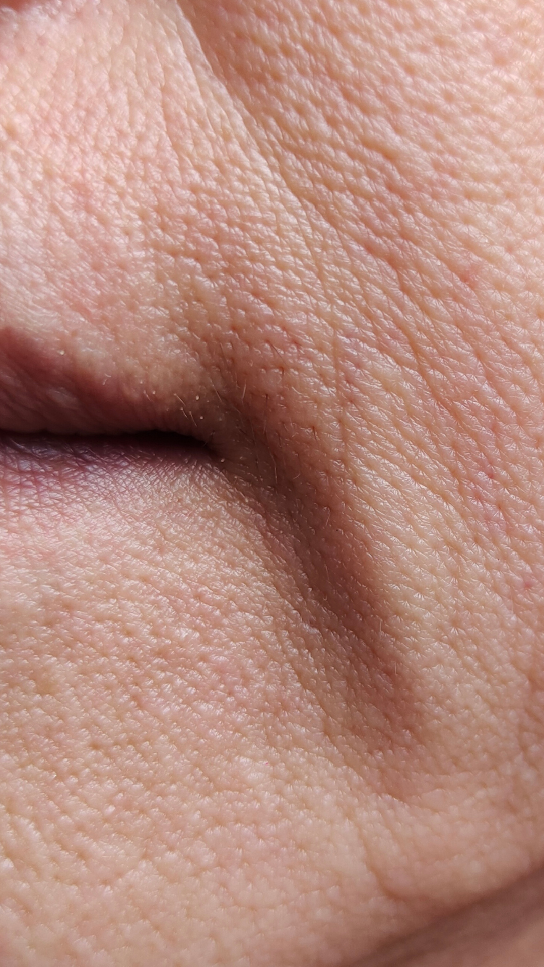 Marionette lines treatment at It’s Me and You Clinic in London, Kingston upon Thames and Surrey – dermal fillers and Botox to smooth marionette lines and lift the lower face.