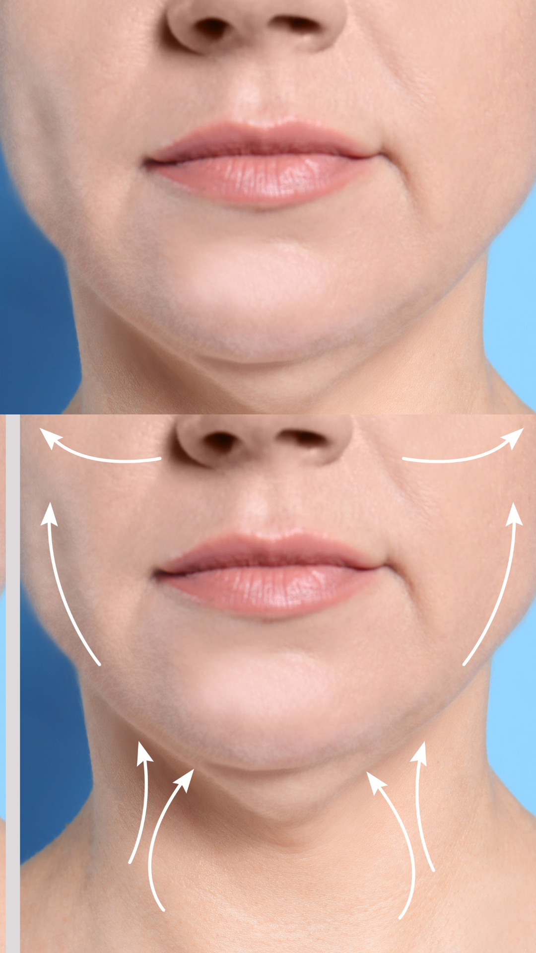 Double chin removal and non-surgical double chin treatments at It’s Me and You Clinic in London, Kingston upon Thames and Surrey – Kybella injections, dermal fillers and skin tightening to reduce chin fat and define the jawline.