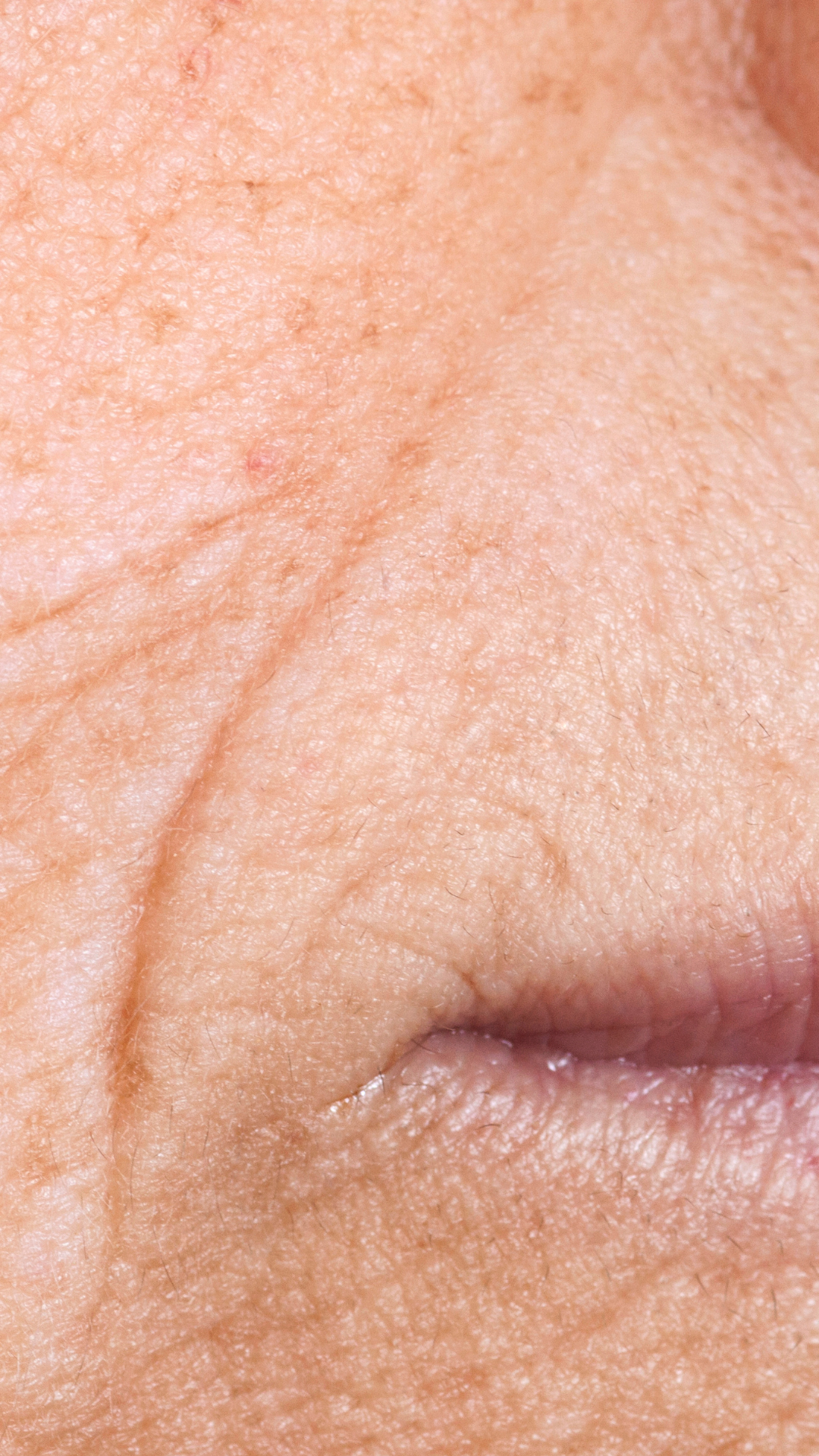 Best nose to mouth lines treatment at It’s Me and You Clinic in Kingston upon Thames, Surrey and London – expert dermal fillers and non-surgical solutions for deep nasolabial folds.