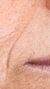 Best Nose to Mouth Lines Treatments in London & Kingston, Surrey – It's Me & You