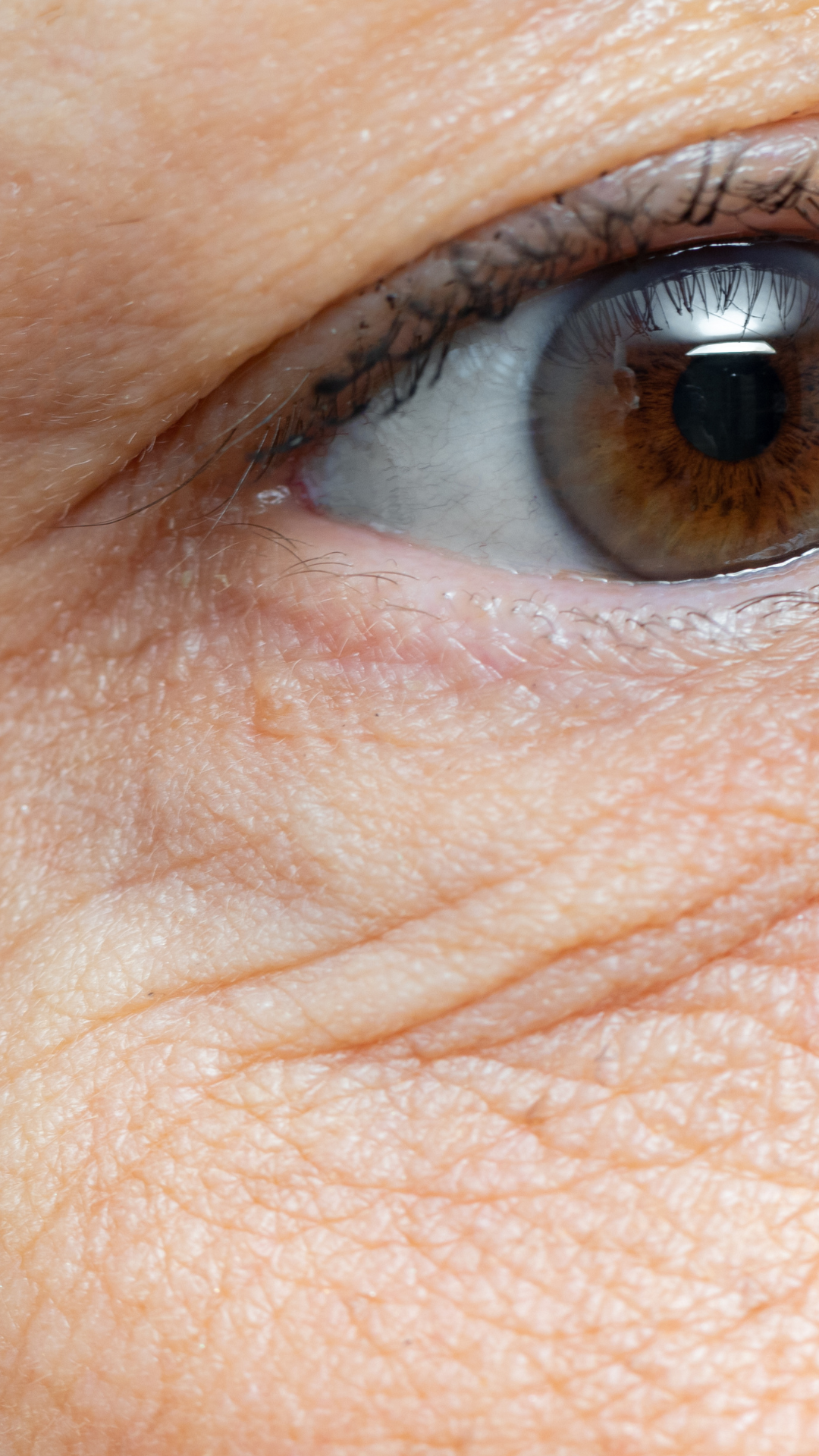 Under eye wrinkles treatment at It’s Me and You Clinic in Kingston upon Thames, Surrey and London – expert solutions including dermal fillers, microneedling, and skin tightening for smoother, younger-looking eyes.
