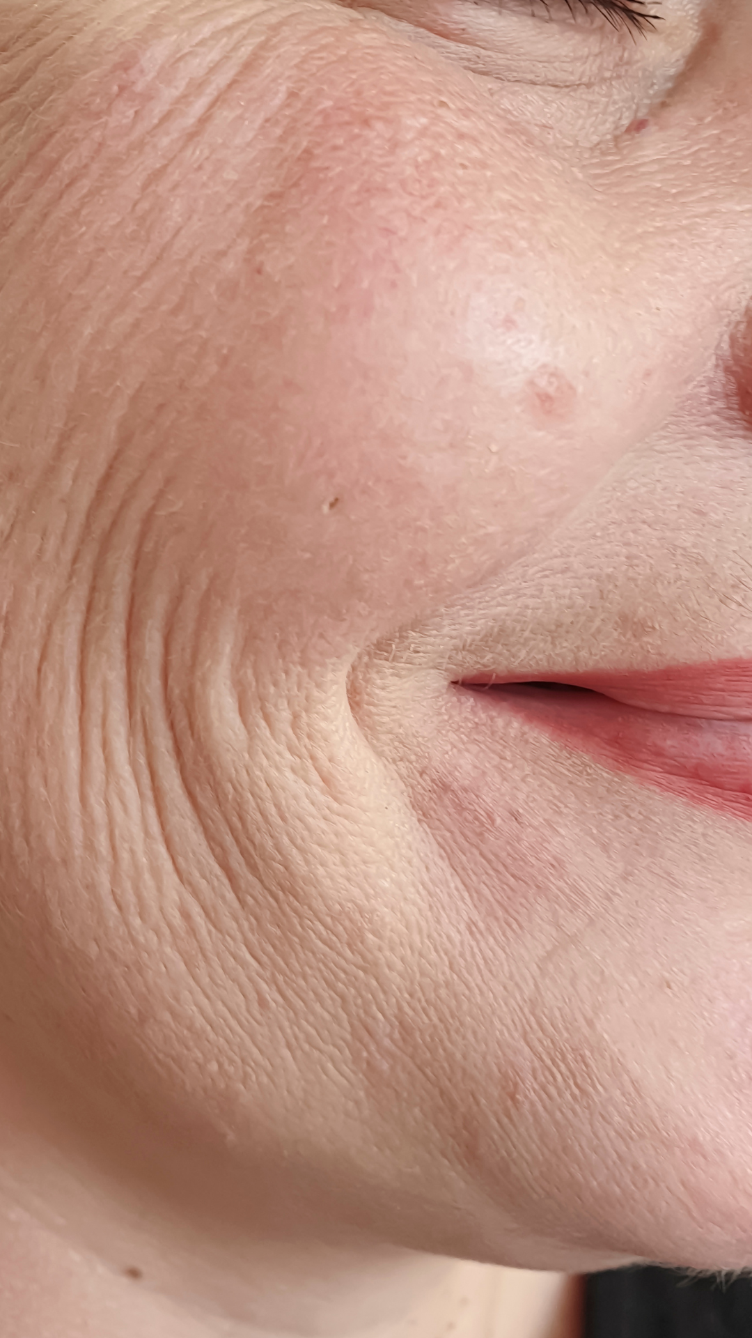 Laughter Lines Treatment in London & Kingston, Surrey – It's Me & You