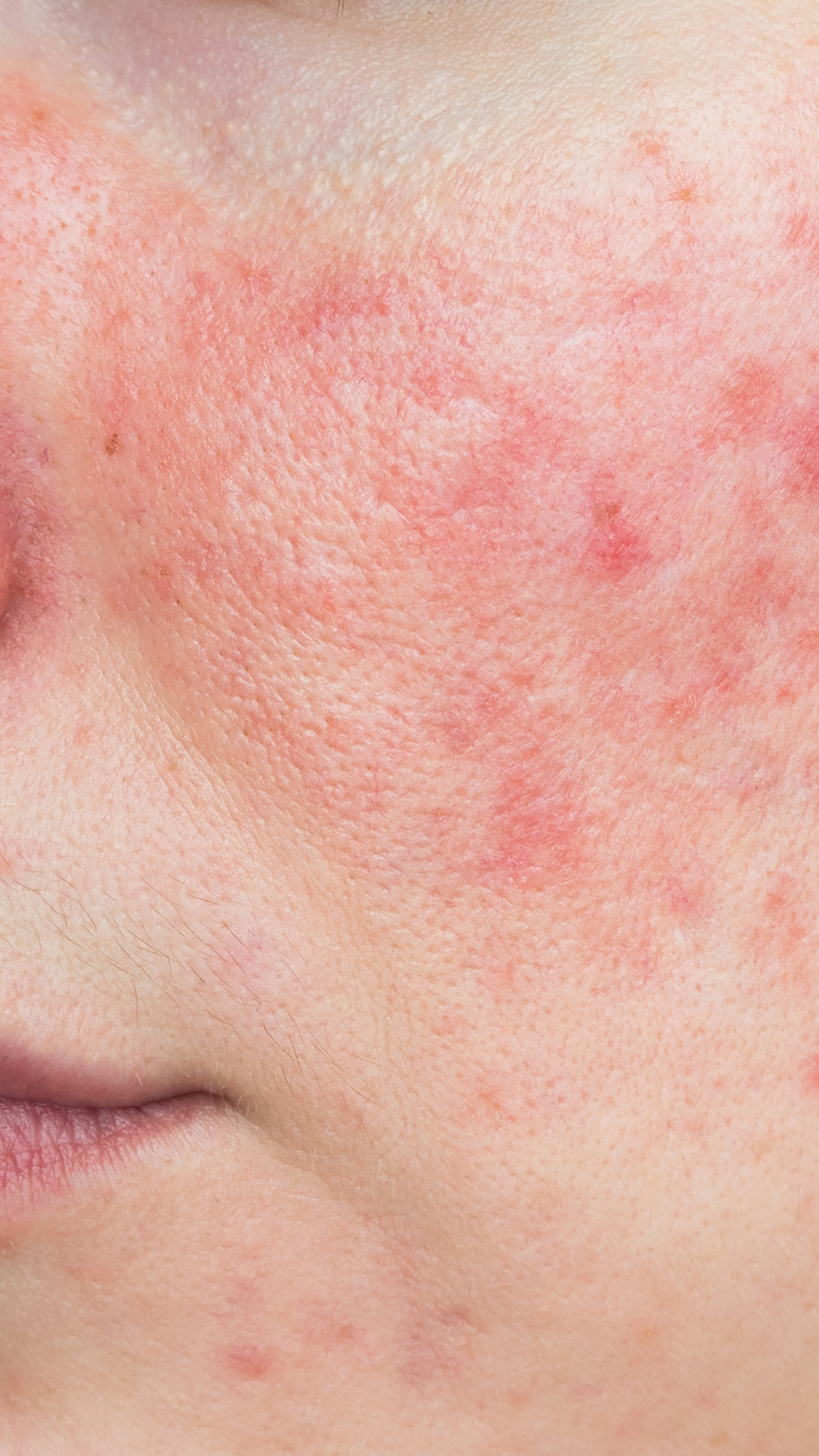 Rosacea Treatment in London & Kingston, Surrey – It's Me & You