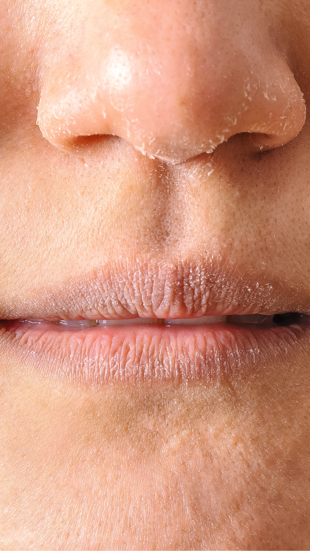 Thin and dry lips treatment at It’s Me and You Clinic in London, Kingston upon Thames and Surrey – lip fillers and skin boosters for lip volume, hydration and smooth texture.