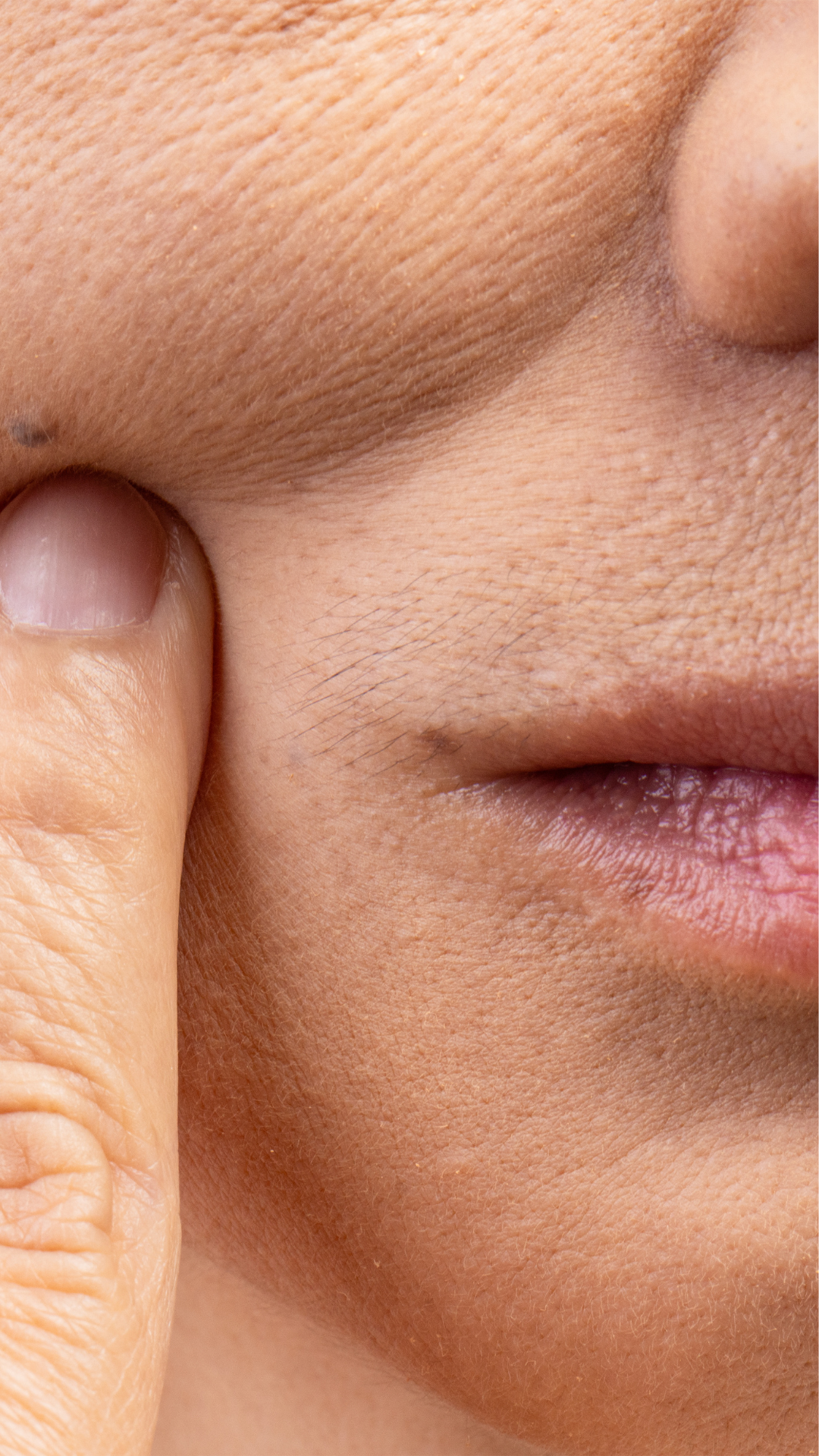 Nose to mouth lines treatment at It’s Me and You Clinic in London, Kingston upon Thames and Surrey – nasolabial fold fillers and anti-wrinkle injections to smooth deep facial lines.