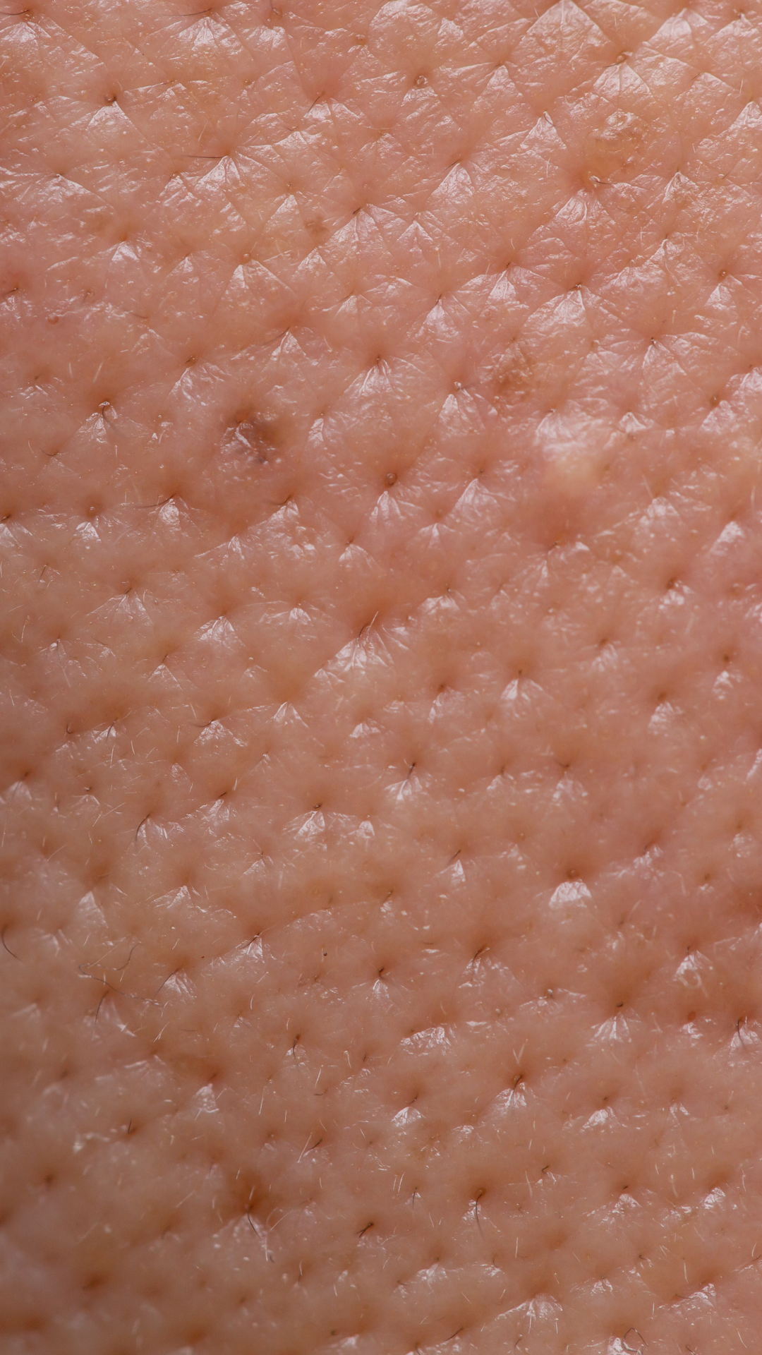 Large pores treatment at It’s Me and You Clinic in London, Kingston upon Thames and Surrey – advanced skincare solutions including microneedling, resurfacing peels and laser therapy to minimise visible pores and refine skin.