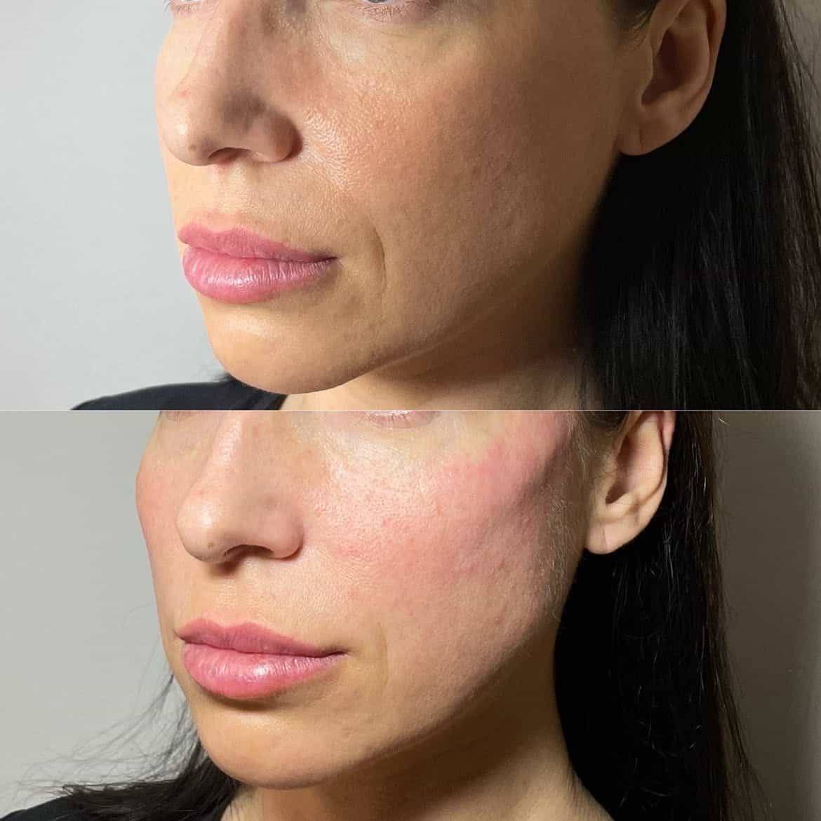 Downturned smile treatment at It’s Me and You Clinic in Kingston upon Thames, Surrey – dermal fillers and Botox to lift mouth corners and restore a youthful, balanced smile.