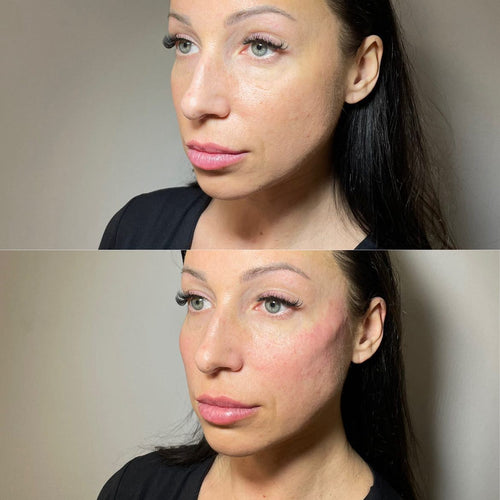 Does Cheek Filler Pull Up Jowls?