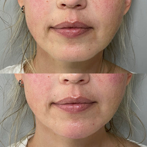 How Lip Filler Change Your Face