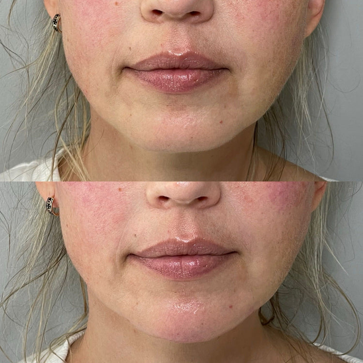 Botox Lip Flip in Hampstead, London
