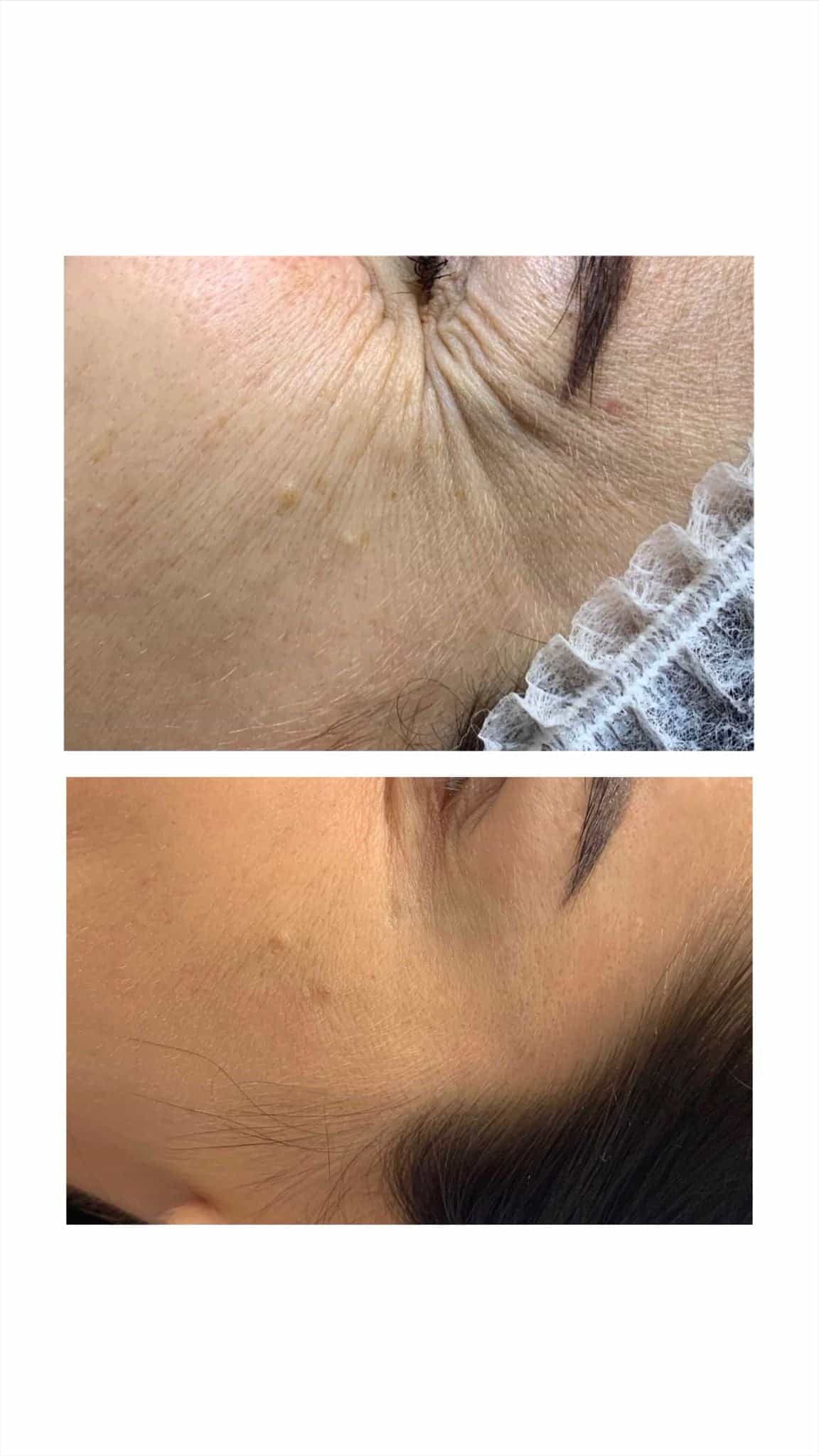 Botox Crows Feet in Chertsey, Surrey