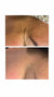 Crow’s feet treatment before and after results at It’s Me and You Clinic in London, Kingston upon Thames and Surrey – visible reduction of eye wrinkles and smoother skin.