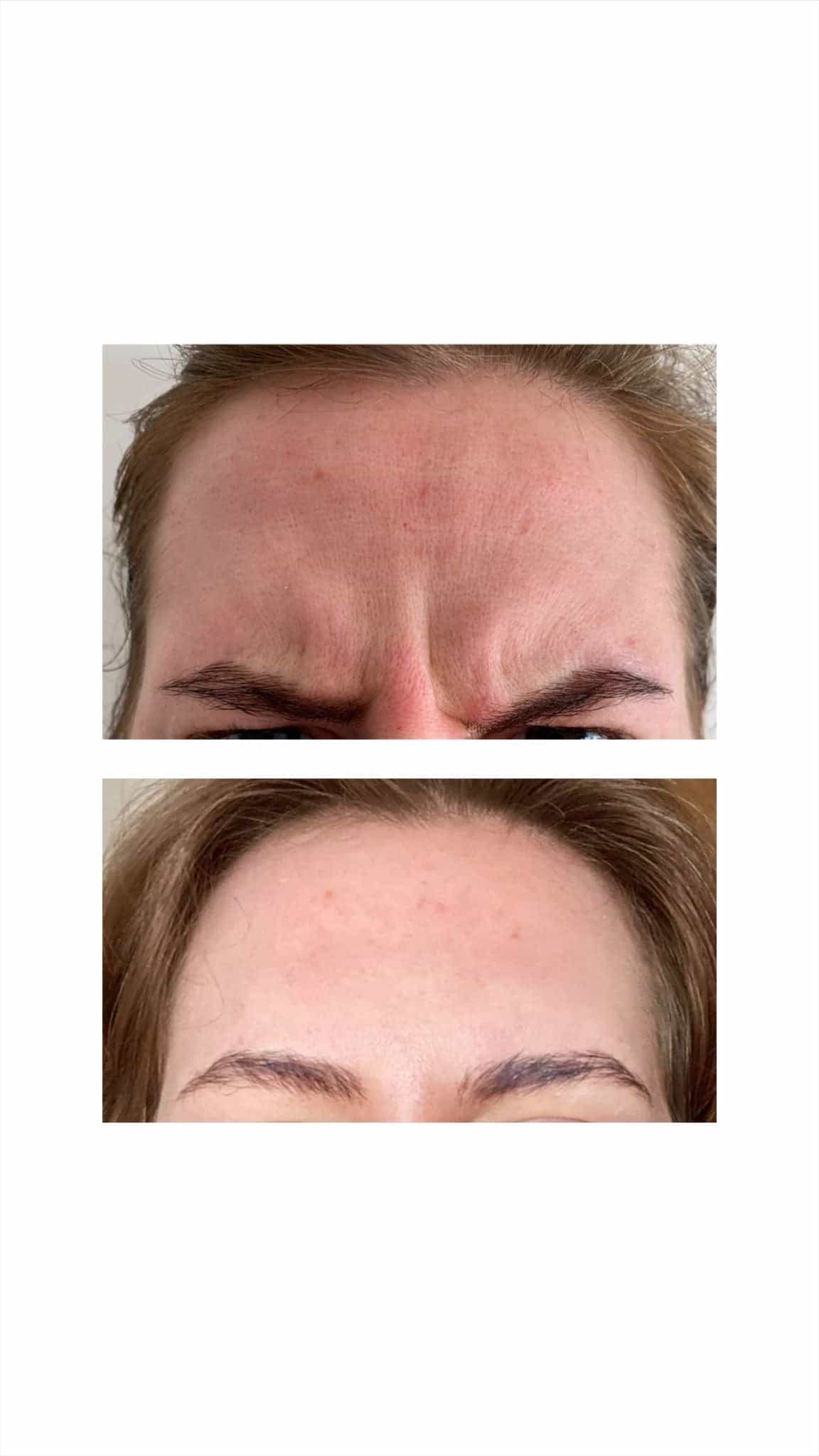 Forehead frown lines treatment at It’s Me and You Clinic in London, Kingston upon Thames and Surrey – Botox and anti-wrinkle injections to smooth frown lines and relax forehead muscles.