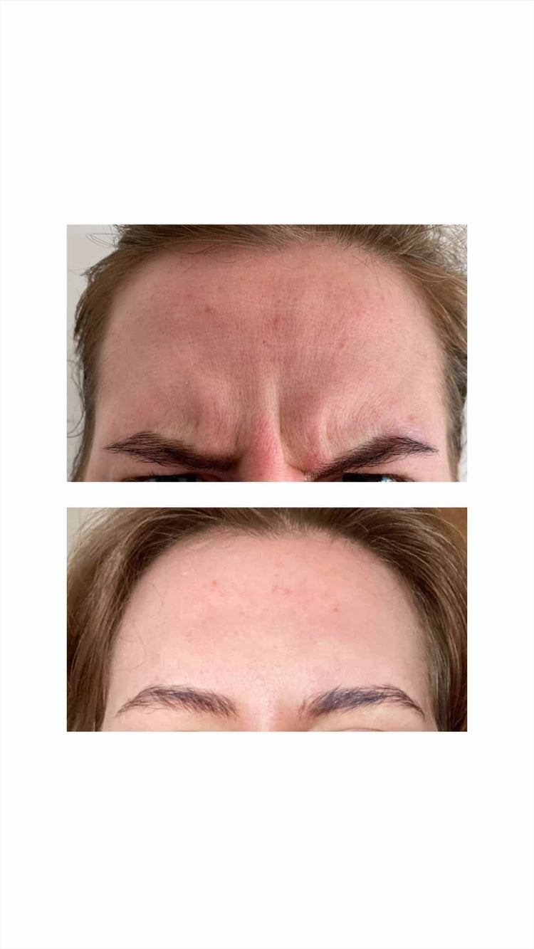 Non-Surgical Eye Rejuvenation Treatment in Windlesham, Surrey