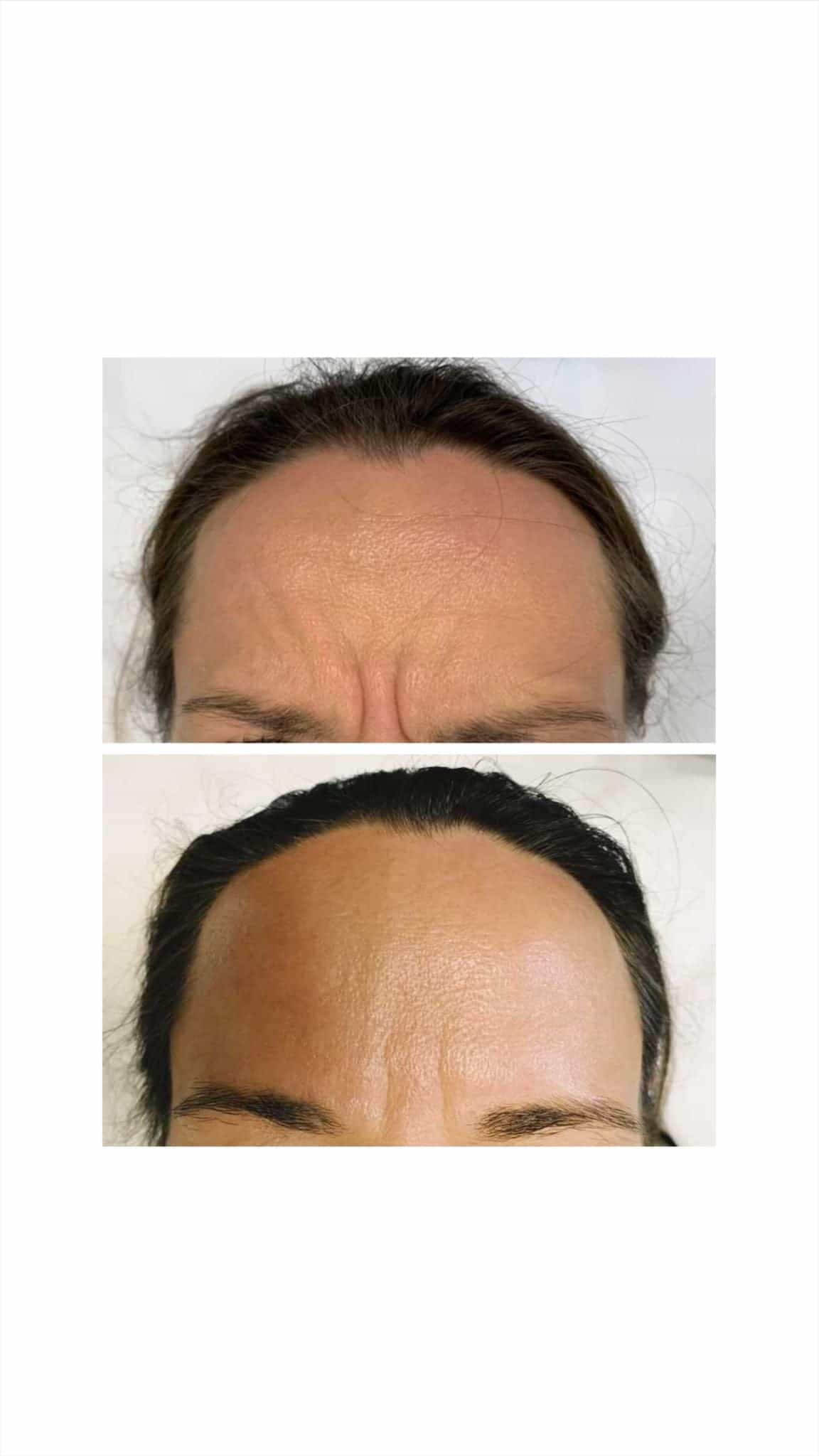 Forehead Frown Lines Treatment – It's Me & You
