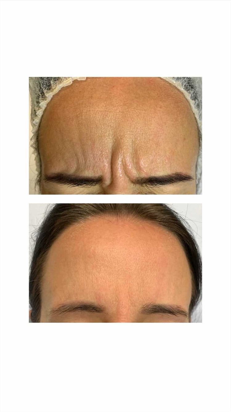 Botox For Square Jaw Reduction in Lightwater, Surrey