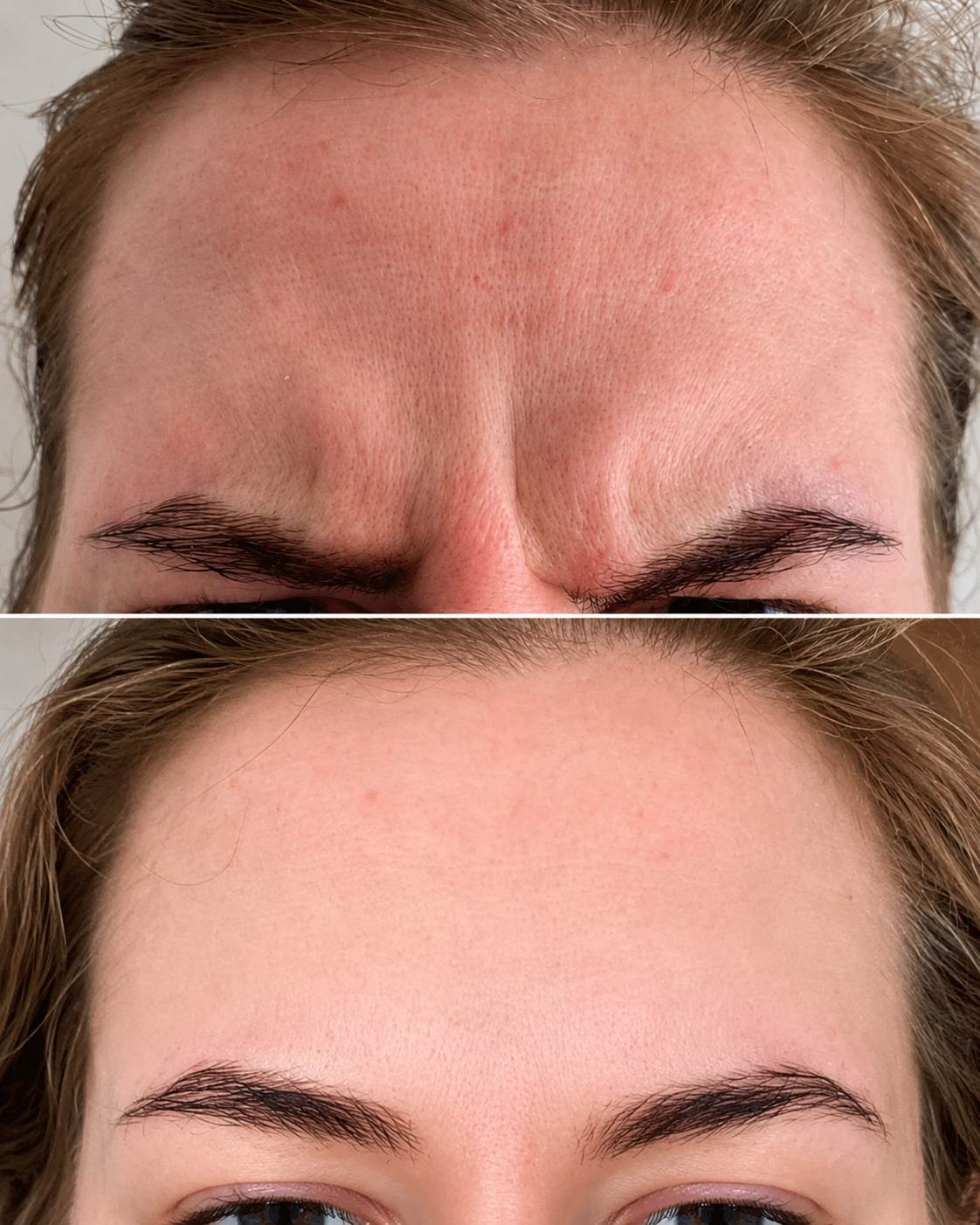 Before and after forehead and frown line treatment image showing a smoother upper face appearance at It’s Me & You Skin Clinic in Kingston upon Thames, Surrey.