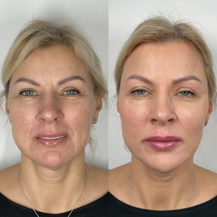 Botox Anti-Wrinkle Treatments in Twickenham, London