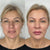 Full face contouring and liquid facelift – non-surgical before and after results at It’s Me & You Clinic Kingston upon Thames, Surrey, London