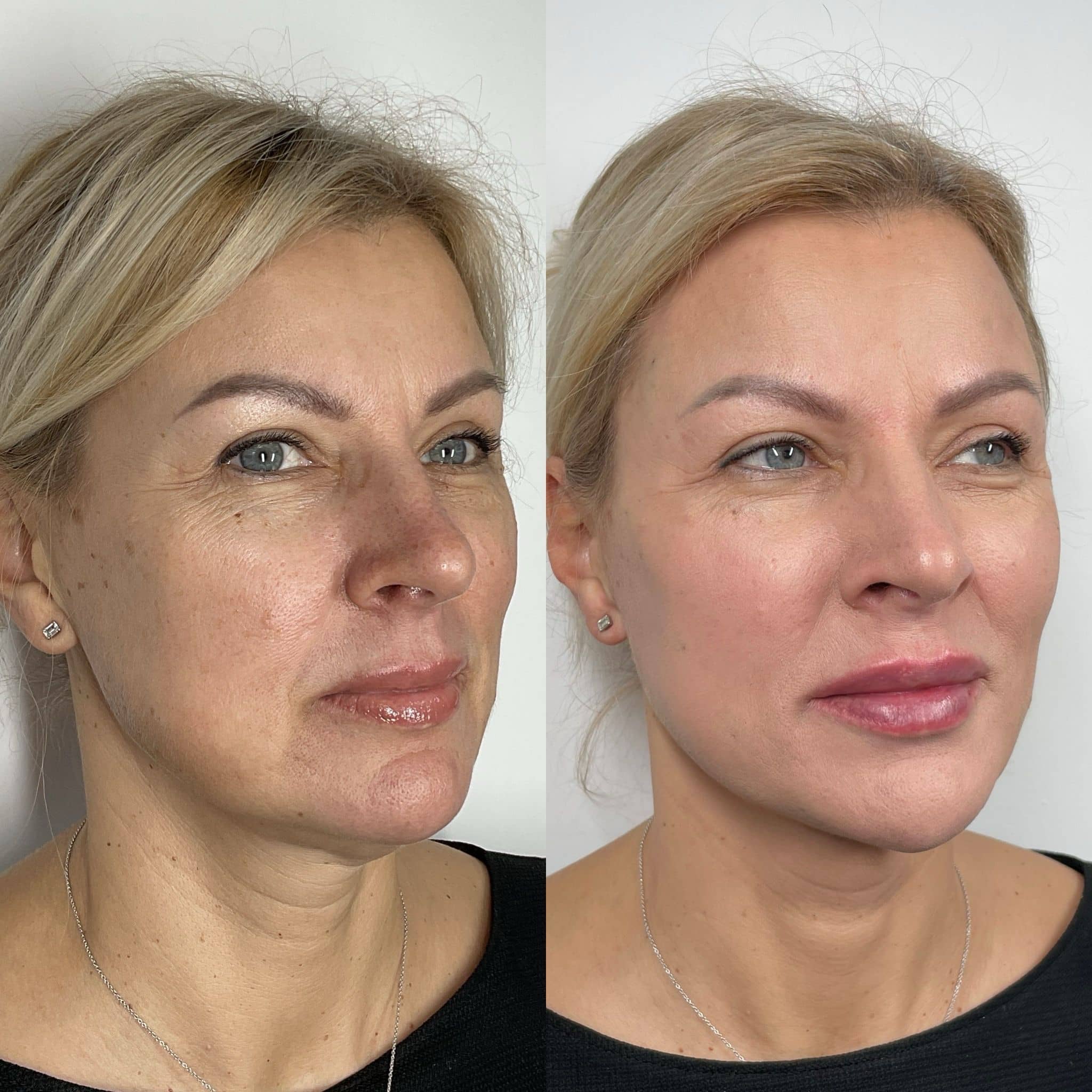 Non-surgical full face contouring and liquid facelift – before and after at It’s Me & You Clinic Kingston upon Thames, Surrey, London