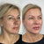 Non-surgical full face contouring and liquid facelift – before and after at It’s Me & You Clinic Kingston upon Thames, Surrey, London