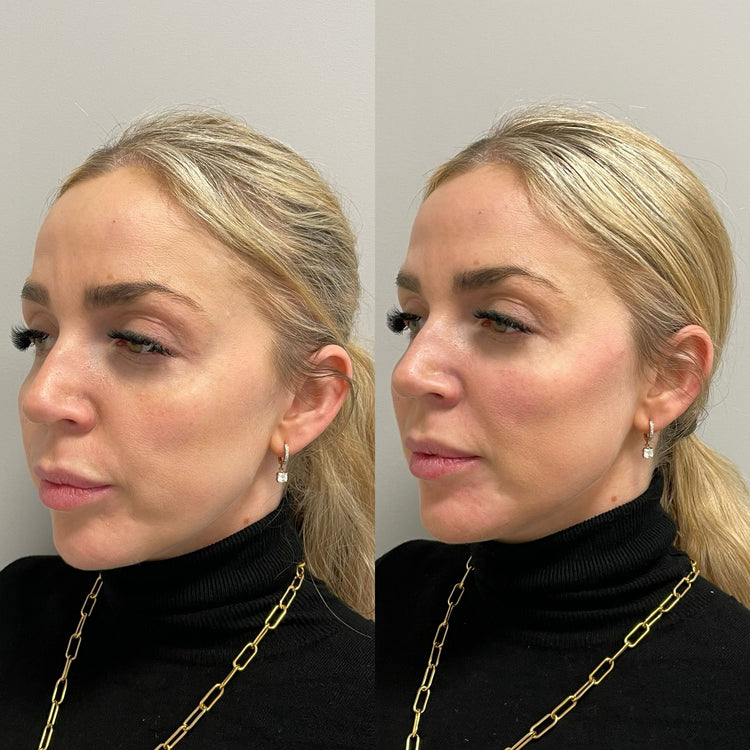Botox Nefertiti Neck Lift in Claygate, Surrey