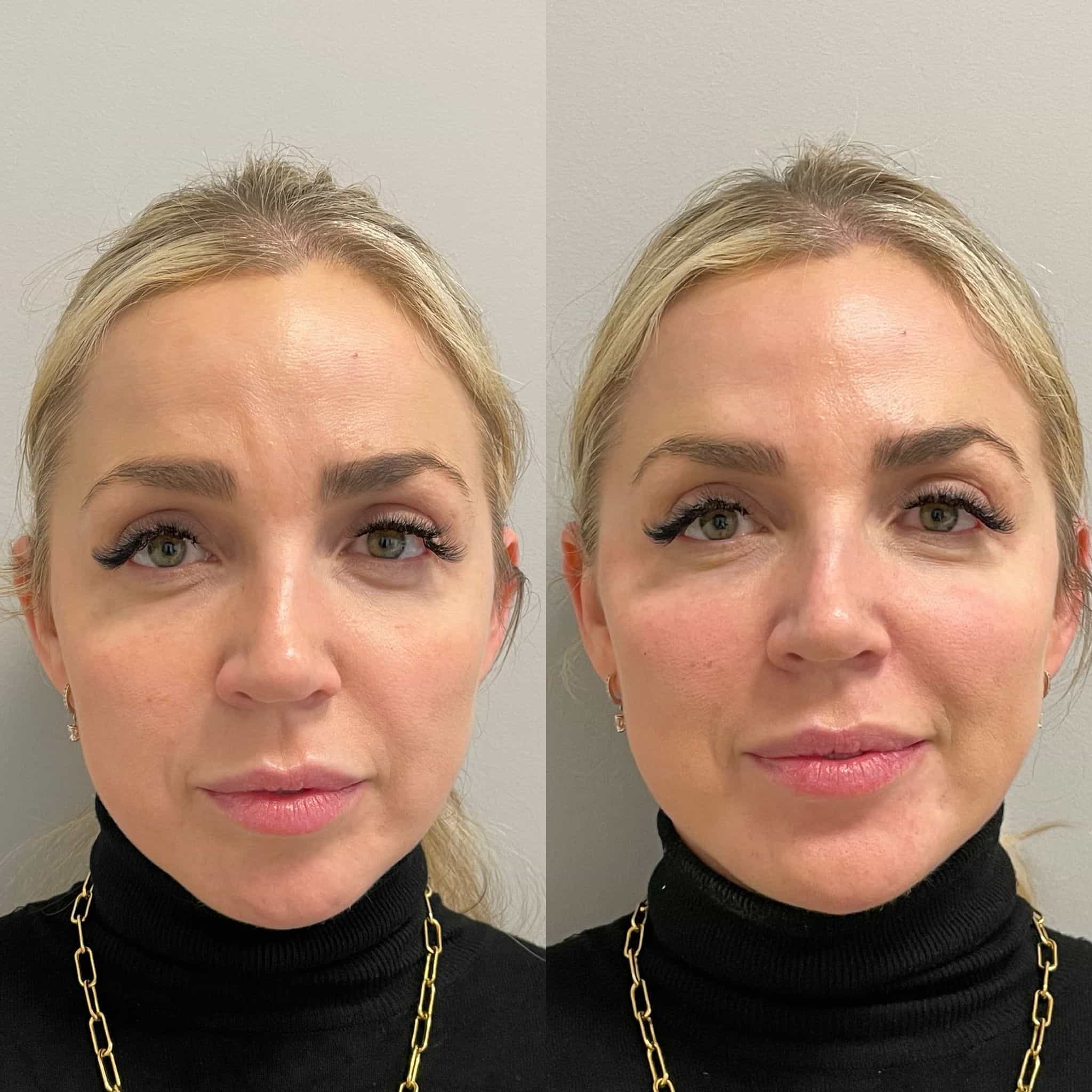 Liquid facelift with Radiesse at It’s Me and You Clinic in Kingston upon Thames, Surrey and London – advanced filler treatment for lifting and volumising ageing skin.
