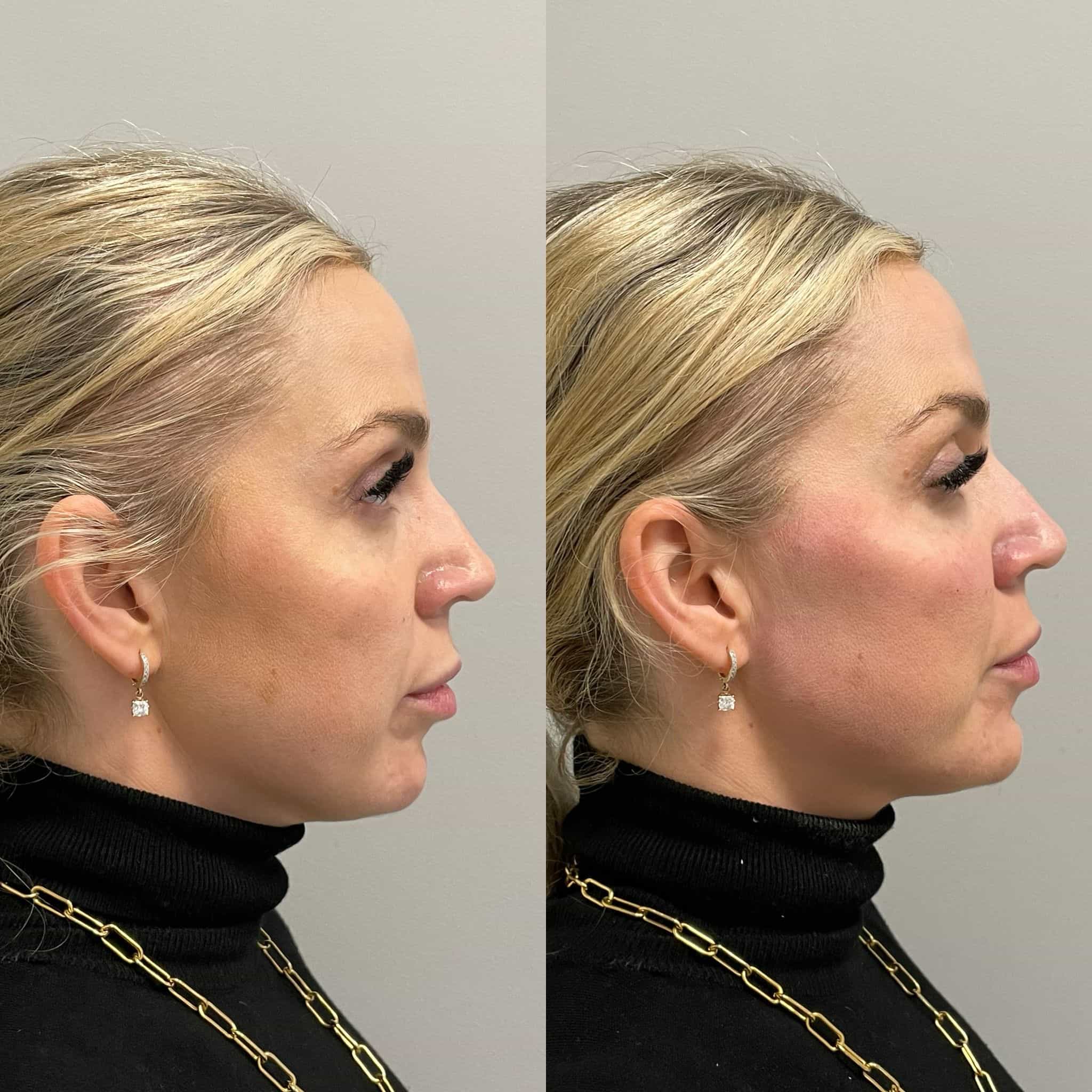 Non-surgical liquid facelift before and after results at It’s Me and You Clinic in London, Kingston upon Thames and Surrey – visible facial lift and contouring with dermal fillers and Botox.
