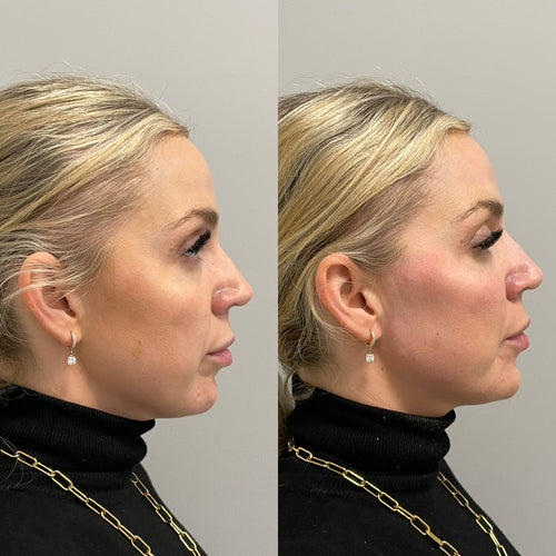 When Can You Shower After Lip Filler