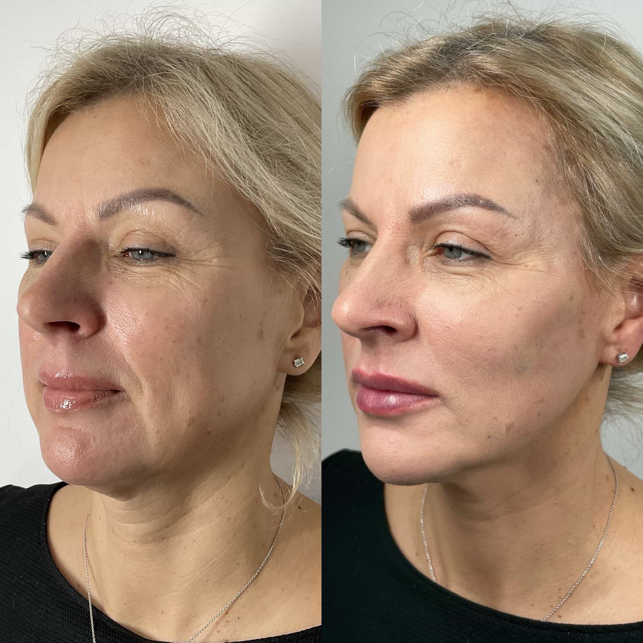 Non-surgical liquid facelift at It’s Me and You Clinic in London, Kingston upon Thames and Surrey – dermal fillers and Botox to lift, contour and rejuvenate the face without surgery.