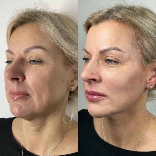 What Is Princess Lip Filler?