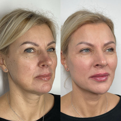 How Expensive Is Lip Filler