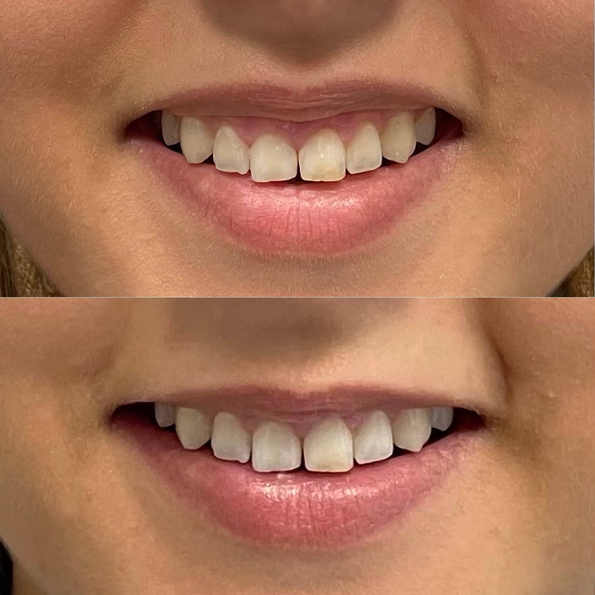 Before and after anti-wrinkle Botox for gummy smile – It’s Me & You Clinic in Kingston, Surrey, London