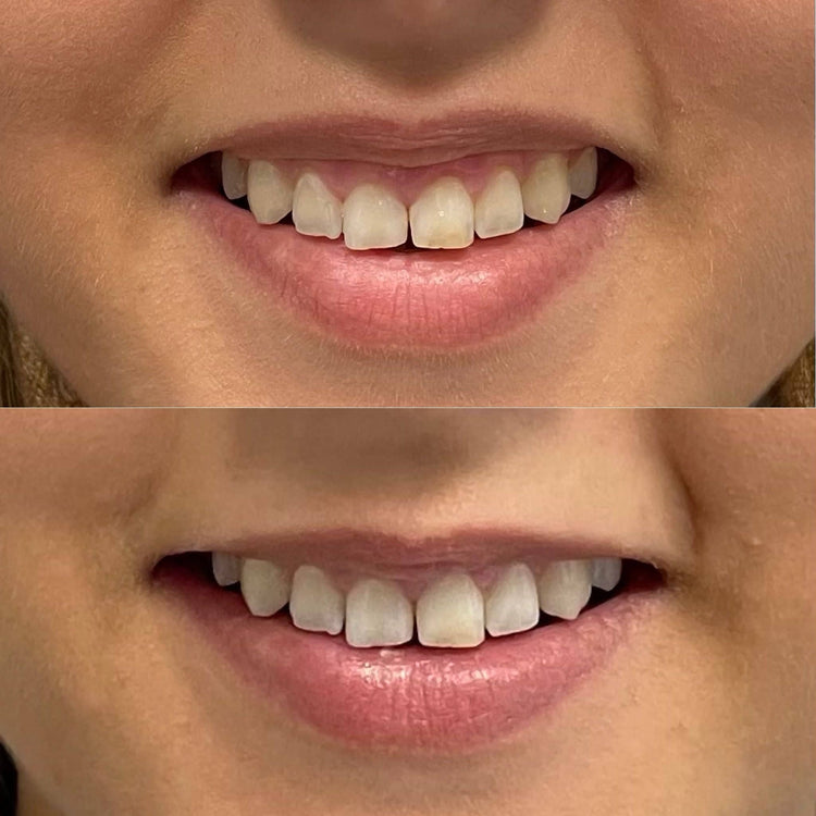 Skin Booster For Smooth Texture in Gomshall, Surrey