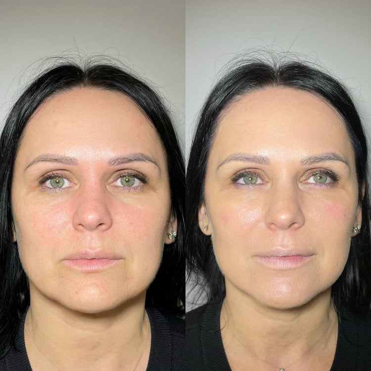 Acne Scar Treatment in Ewell, Surrey
