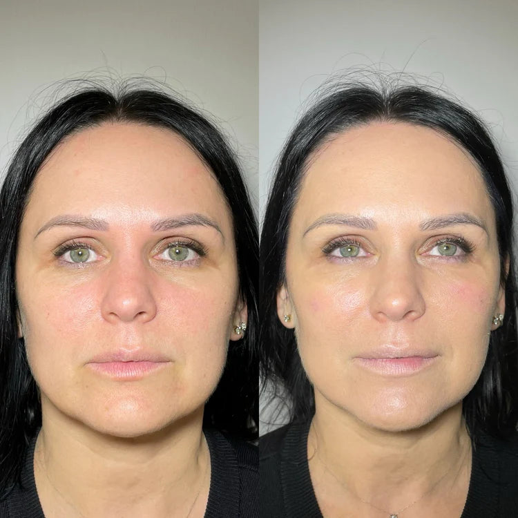 Botox Before And After