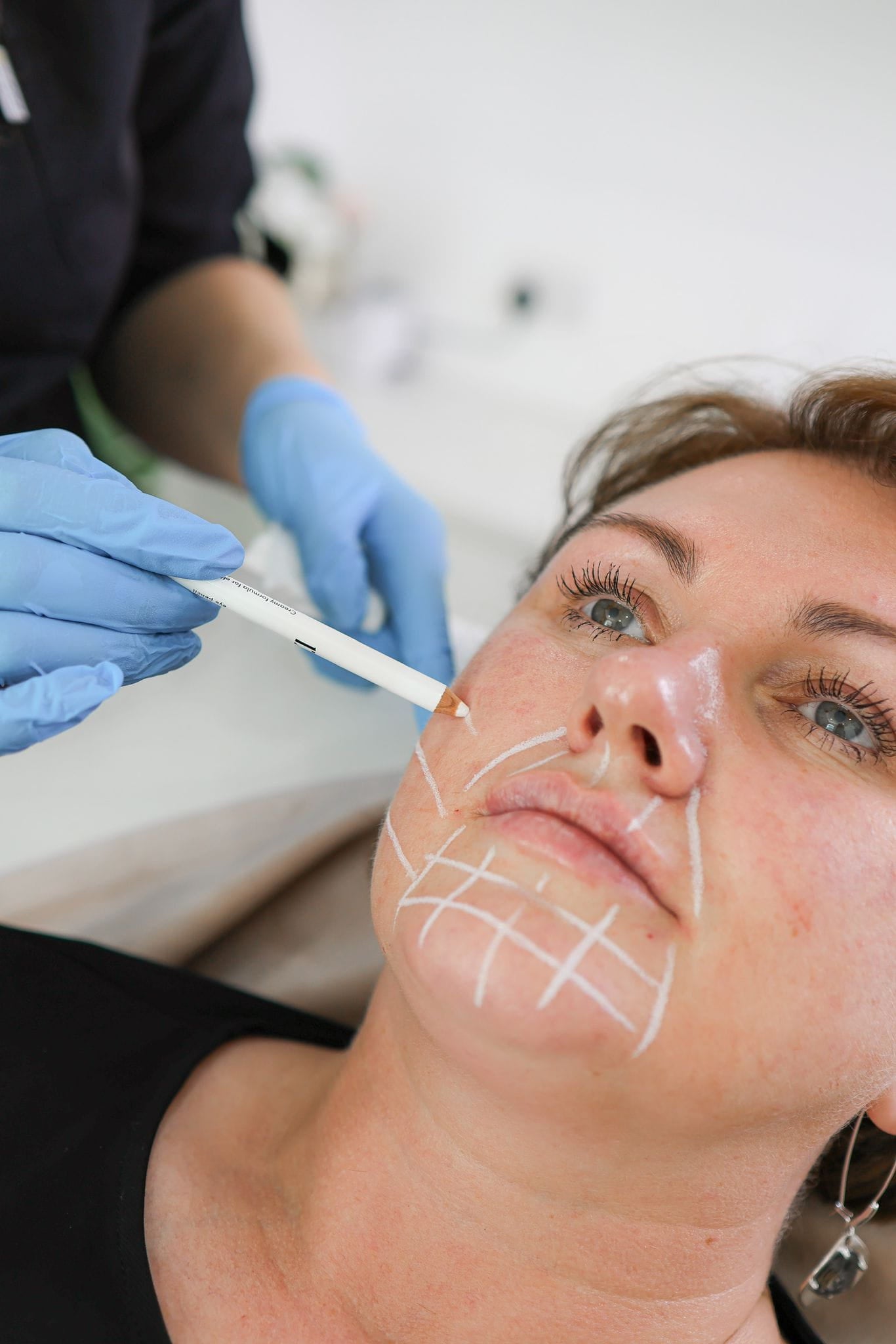 Baby Botox in Chiswick, London