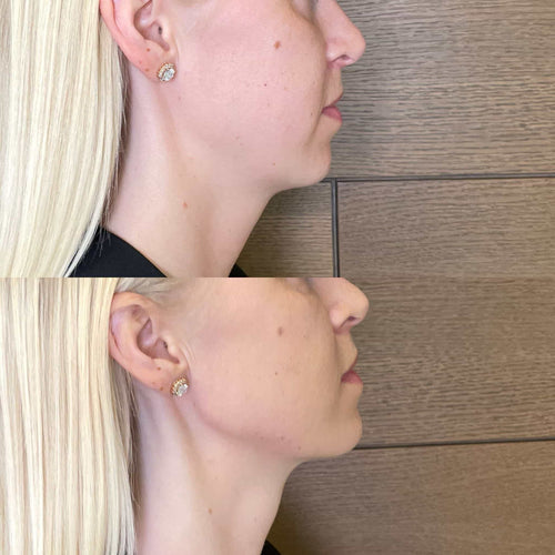 Do adults have nasal flaring?