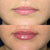 Lip Filler Injections in Kingston, Surrey, London