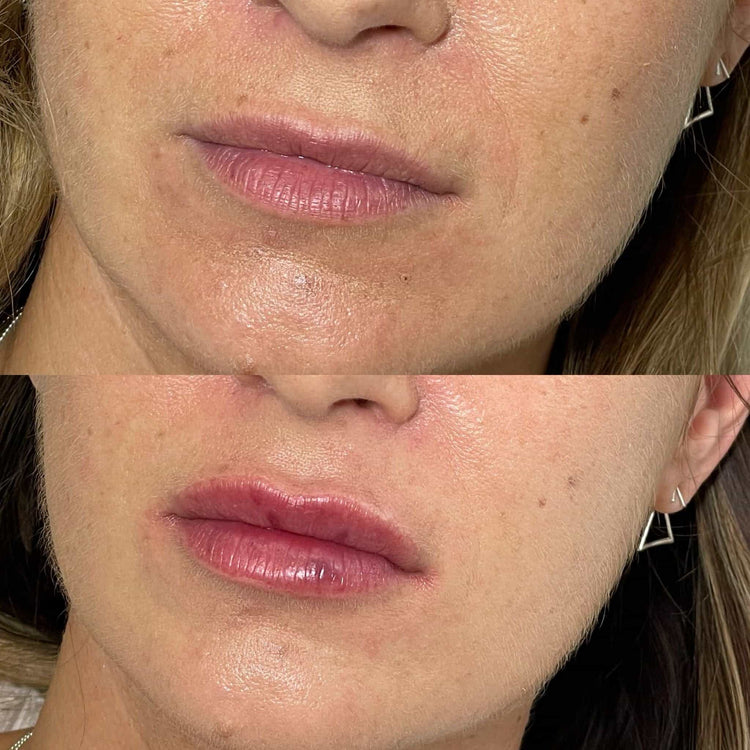 Skin Tone Balancing Peels in Wotton, Surrey