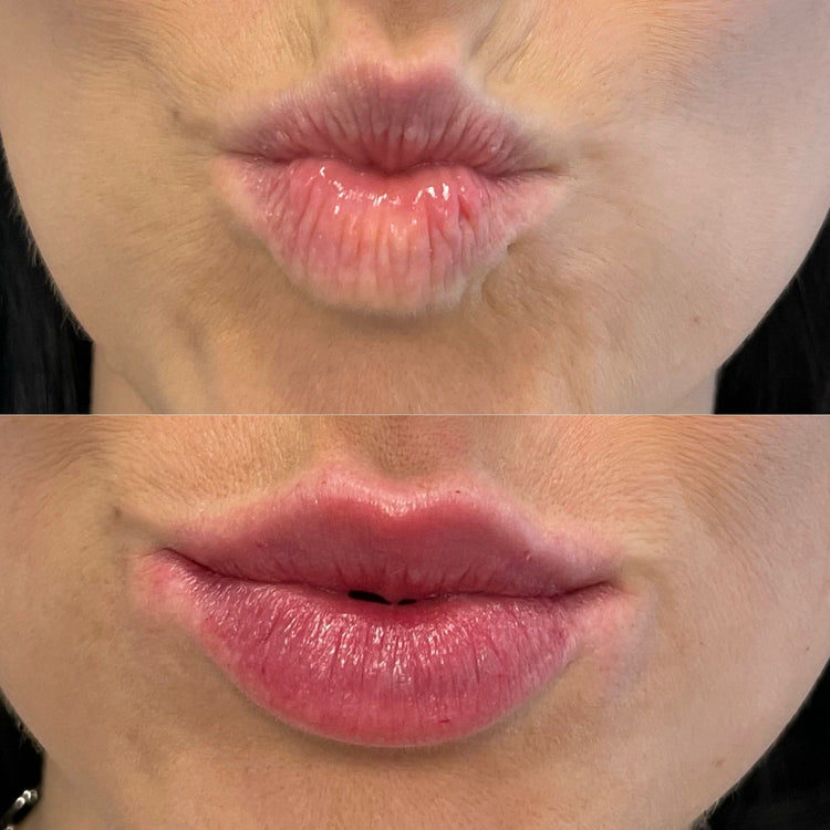 Can Filler Dissolving Treatment correct overfilled lips