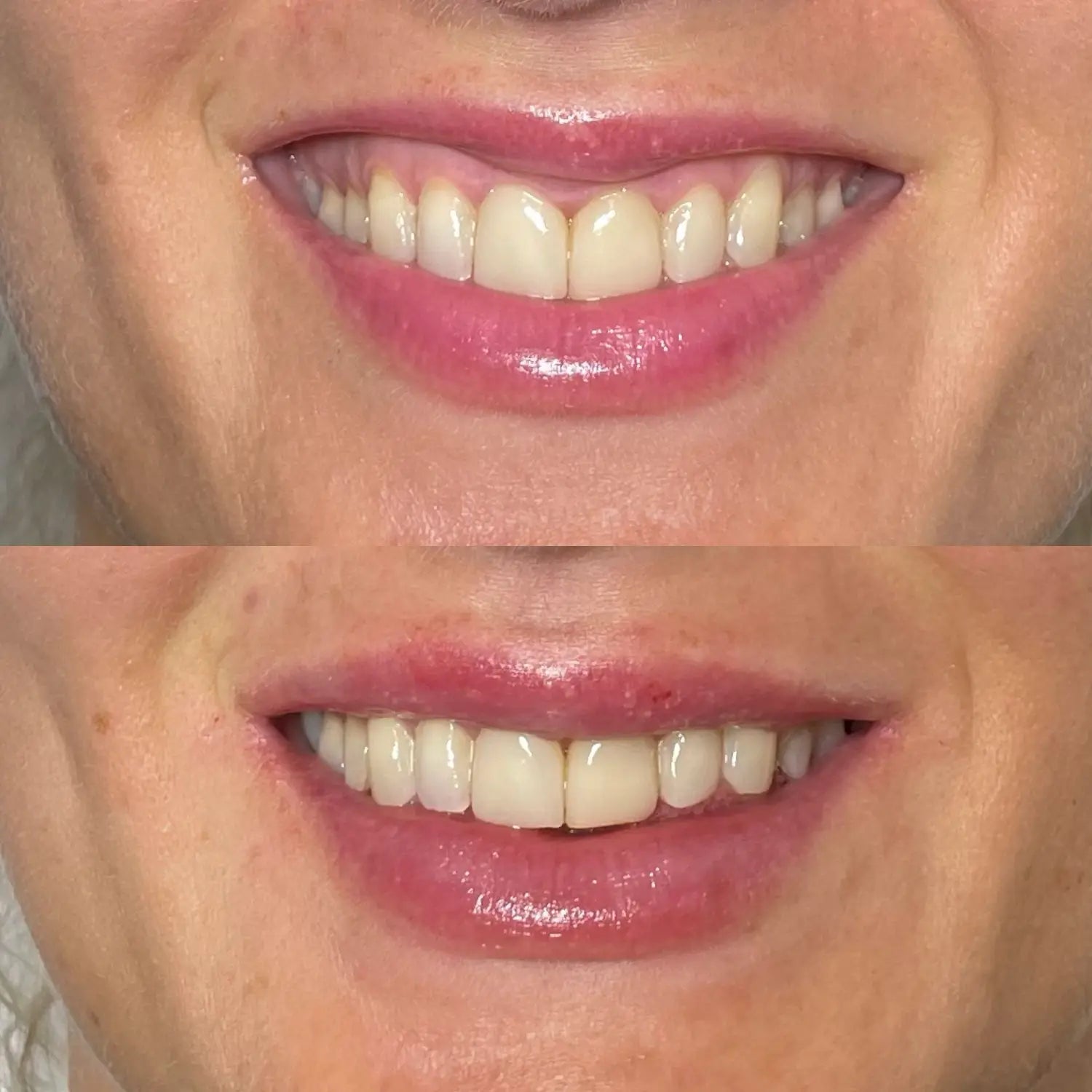 Lip Flip Before And After