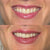 Lip Filler Injections in Kingston, Surrey, London
