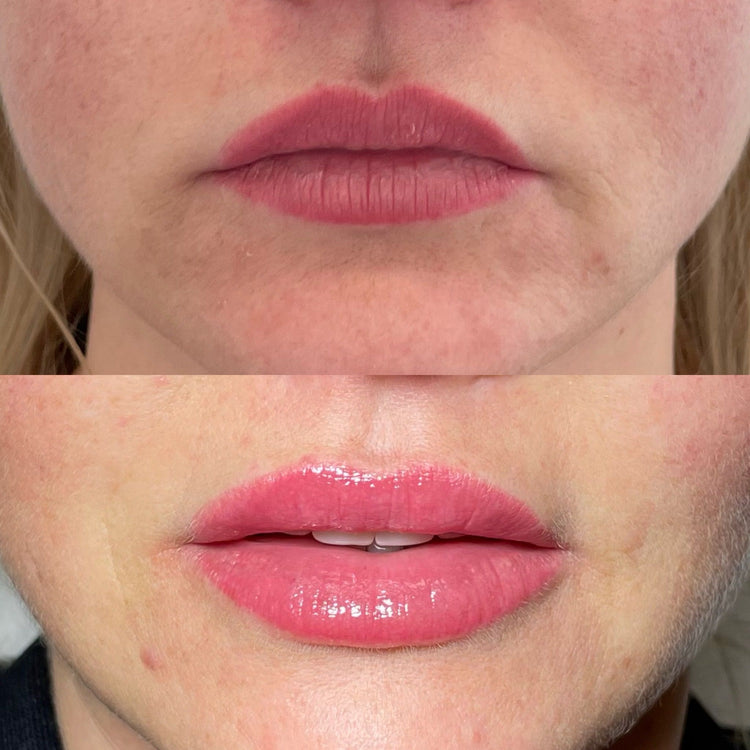 Botox Forehead Frown Lines in Oxshott, Surrey