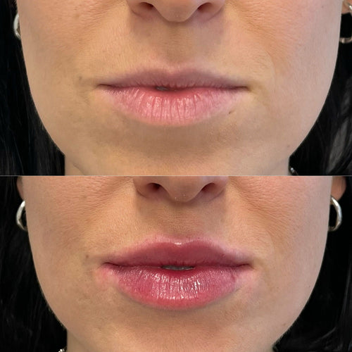 Is 1ml filler enough for nasolabial folds?